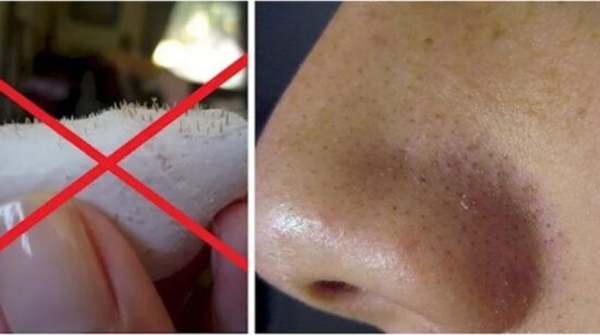 Siyah nokta temizleme için bitkisel çözümler! Kökünden çözeceksiniz