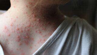 Su çiçeğine ne iyi gelir? Su çiçeğine iyi gelen yiyecekler ile evde tedavi desteklenebilir!