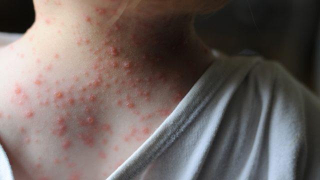 Su çiçeğine ne iyi gelir? Su çiçeğine iyi gelen yiyecekler ile evde tedavi desteklenebilir!