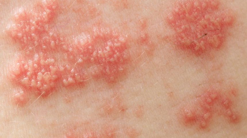 Zona: Nedenleri, belirtileri, tedavisi