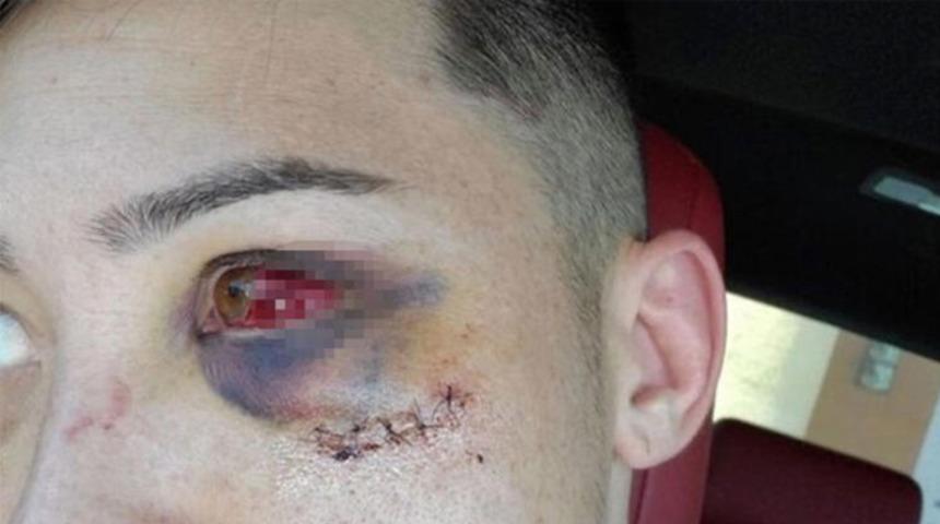 MMA dövüşcüsü Boston Salmon sakatlandı! Shawn West'in tekmesi...