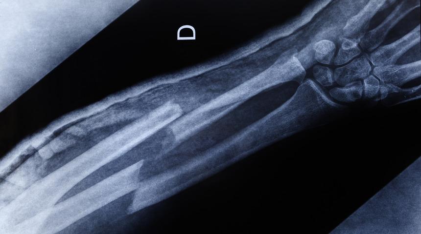 Kemik kaynamasında sigara uyarısı: İyileşmeyi geciktiriyor