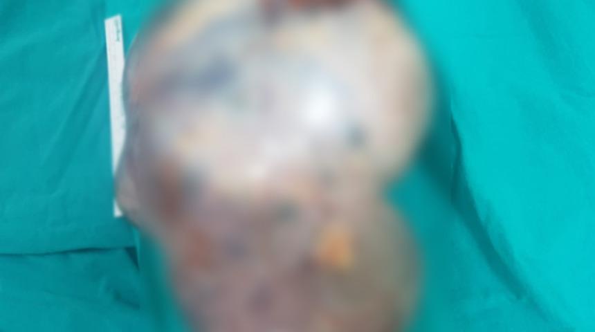 Karnında şişkinlik şikayetiyle has gitti! Doktor g&ouml;zlerine inanamadı