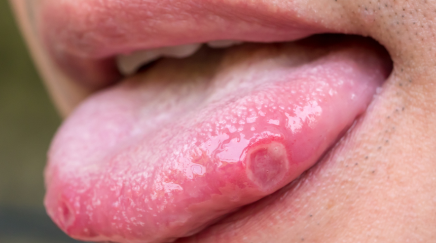 Dil yarası: Neden olur, nasıl geçer?