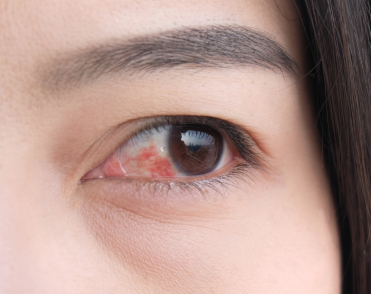 Göz kanlanması : Neden olur, nasıl geçer? - Sağlık Haberleri