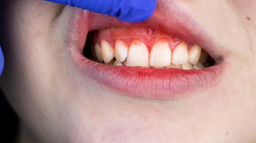 Diş eti ağrısı: Neden olur, nasıl geçer?
