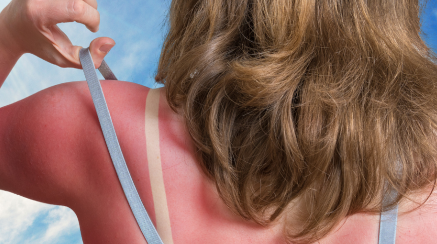Güneş yanığı: Neden olur, nasıl geçer?