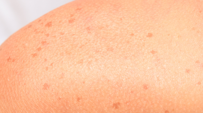 Güneş lekeleri: Neden olur, nasıl geçer?