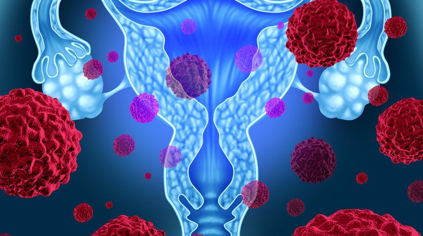 Yumurtalık kisti: Nedenleri, belirtileri, tedavisi