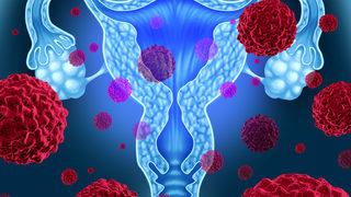 Yumurtalık kisti: Nedenleri, belirtileri, tedavisi