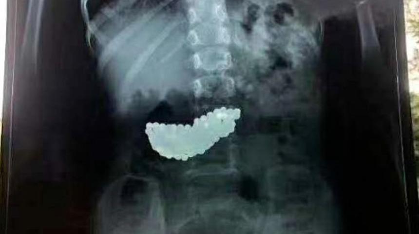 &Ccedil;in'de 5 yaşındaki &ccedil;ocuk 2 ay boyunca midesinde 190 bilyeyle yaşadı