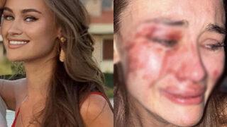 Dünyaca ünlü model Daria Kyryliuk darp edildiğini iddia etmişti! Yeni gelişme