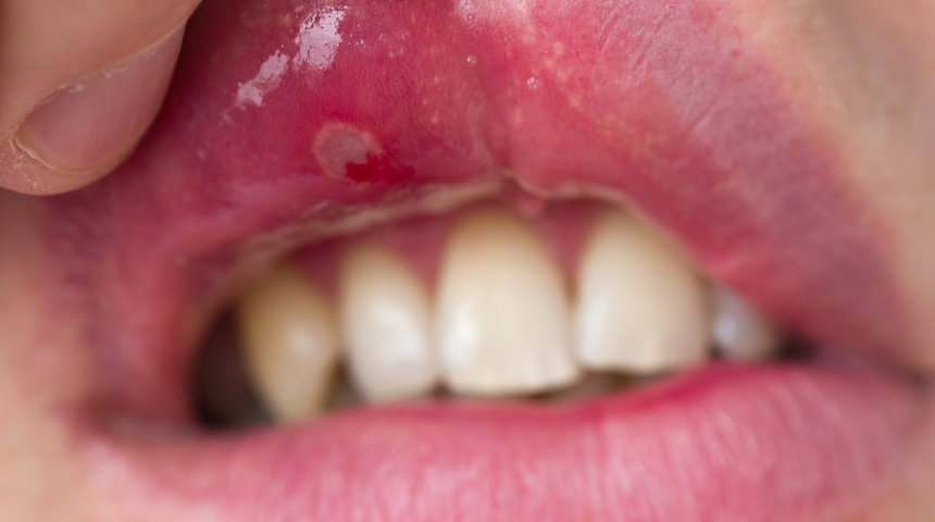 Aft: Neden olur, nasıl geçer?