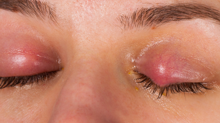 Arpacık: Neden olur, nasıl ge&ccedil;er?