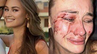 Çeşme'de dövüldüğünü öne süren Ukraynalı model Daria Kyryliuk'in soruşturmasında yeni gelişme!