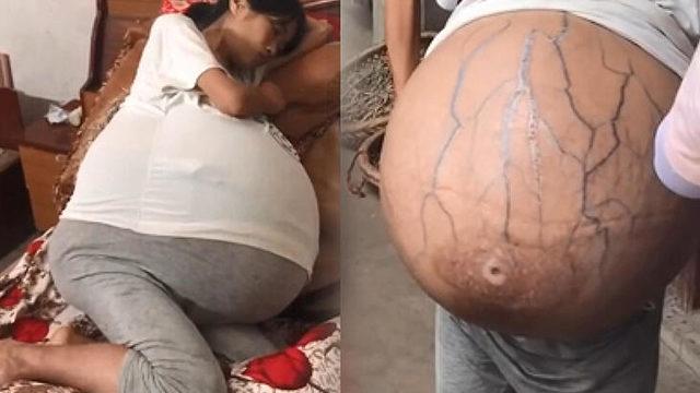Tıp dünyası şaşkın: Karnından çıkarıldı, 20 kilo ağırlığında