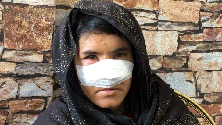 Kocası tarafından burnu kesilen Afgan kadın Zarka: Ölüm korkusuyla yıllar geçti