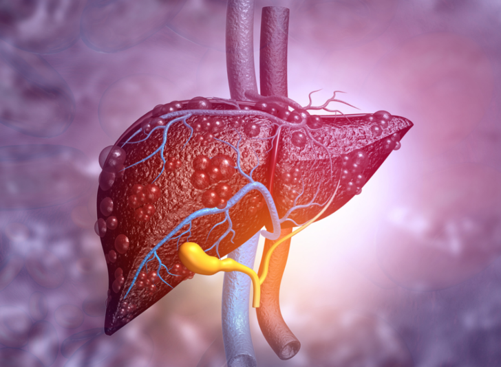 Karaciğer yetmezliği nasıl anlaşılır, belirtileri nelerdir?