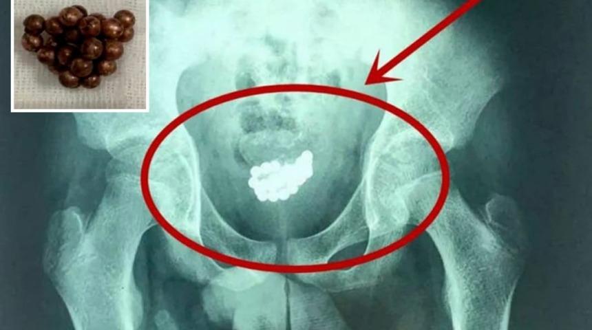 Şiddetli ağrıyla hastaneye gitti, penisinden 29 bilye &ccedil;ıkarıldı