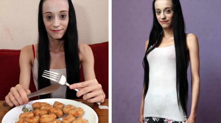 Yeme bozukluğu nedeniyle sadece tavuk nugget yiyen kadın kör kalabilir