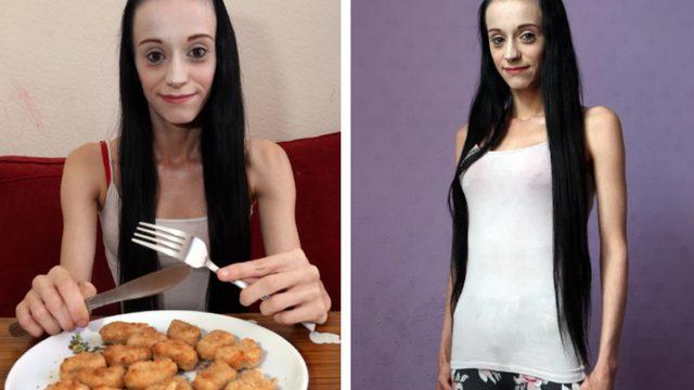 Yeme bozukluğu nedeniyle sadece tavuk nugget yiyen kadın kör kalabilir