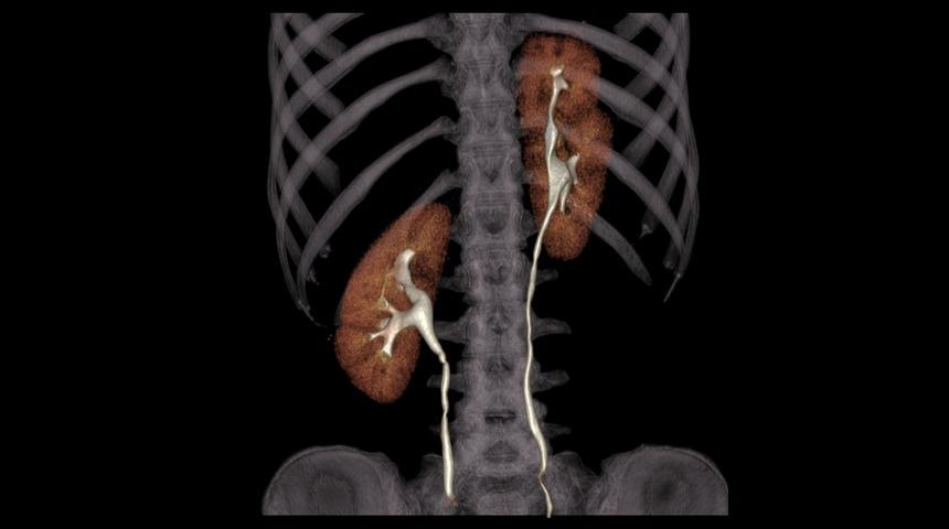 Robotik b&ouml;brek nakli nedir? İşte Ukraynalı kadını T&uuml;rkiye'de sağlığına kavuşturan o y&ouml;ntem