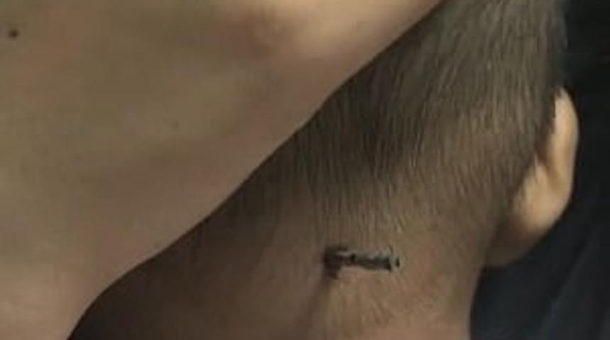 &Ccedil;in'de kafasına &ccedil;elik &ccedil;ubuk saplanan &ccedil;ocuk mucize eseri kurtuldu