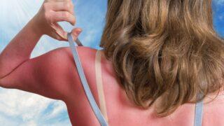 Yanığa ne iyi gelir? Yanık acısına iyi gelen doğal yöntemler