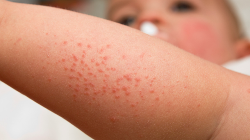 İsilik: Neden olur, nasıl geçer?