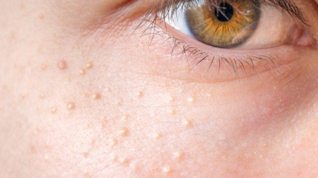 Yağ bezesi: Neden olur, nasıl geçer?