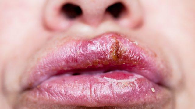 Uçuk: Neden olur, nasıl geçer?