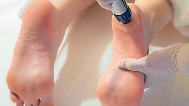 Topuk dikenine ne iyi gelir? Topuk dikeni nasıl geçer, ağrısı için doğal çözümler