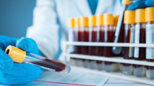 MCH nedir? MCH yüksekliği, düşüklüğü, normal değeri