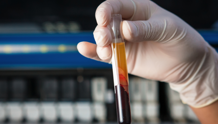 LDH nedir? LDH düşüklüğü, yüksekliği, normal değeri Sağlık Haberleri