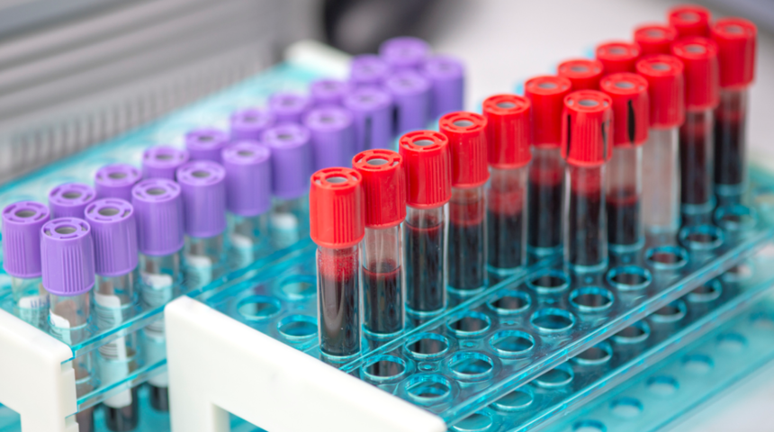 Üre nedir? Üre (BUN) yüksekliği, düşüklüğü, normal değeri