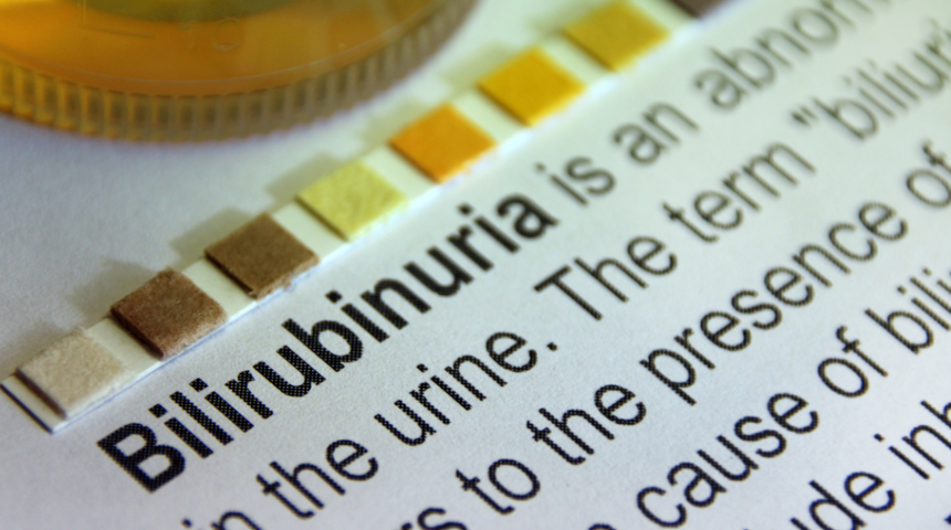 Bilirubin nedir? Bilirubin düşüklüğü, yüksekliği, normal değeri