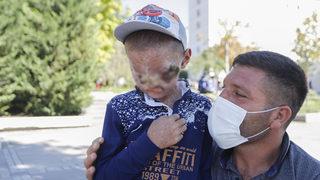 Cilt kanseri 8 yaşındaki Salih'in tedavisi Ankara'da başladı