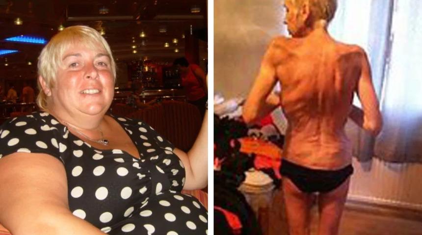 Mide ameliyatı başarısız olan kadın 38 kiloya d&uuml;şt&uuml;