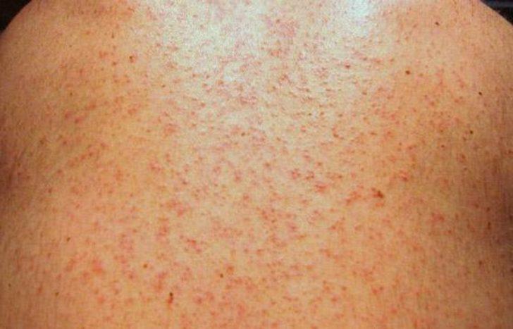 Koronavirüsün cildinizde neden olabileceği 8 semptom