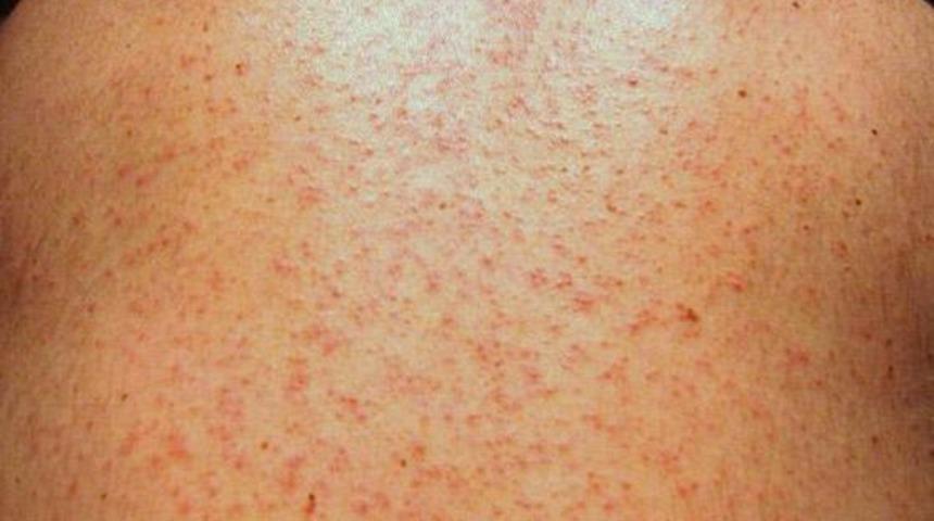 Koronavirüsün cildinizde neden olabileceği 8 semptom