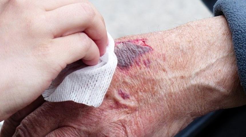 Ciltte oluşan morluklardan daha kısa s&uuml;rede kurtulmak m&uuml;mk&uuml;n! Ananas, arnika...