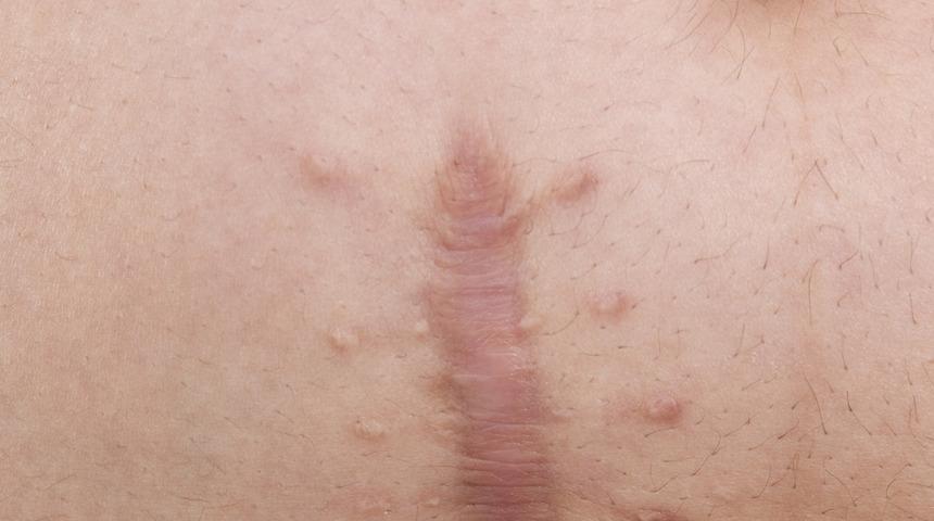 Bebek gibi olalım: Her t&uuml;rl&uuml; yara izini ortadan kaldıran y&ouml;ntemler