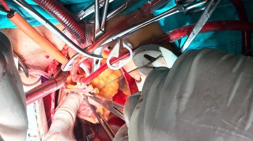 Afyonkarahisar&rsquo;da kalbe yerleşen 5 santimlik t&uuml;m&ouml;r ameliyatla alındı