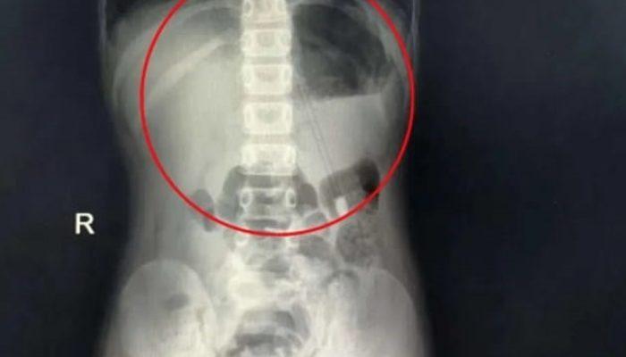 7 yaşındaki bir çocuğun boğazından 18 cm’lik kalem çıkartıldı