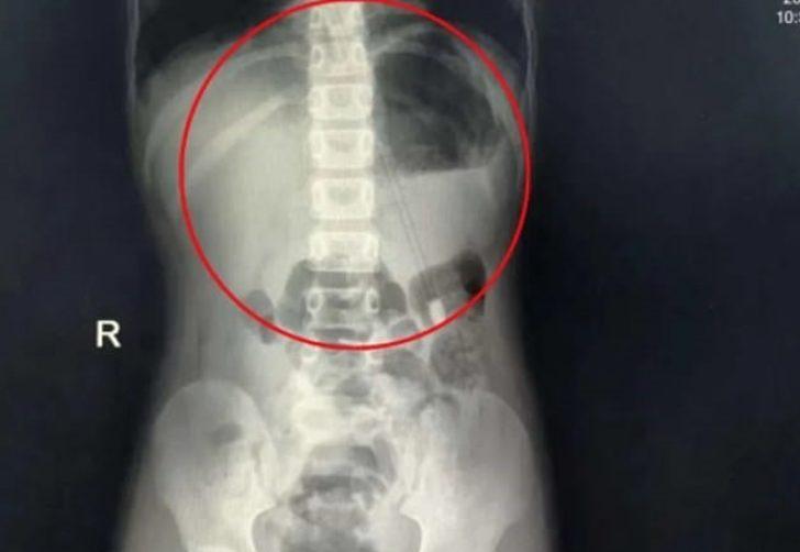 Çin’de 7 yaşındaki bir çocuğun boğazından 18 cm’lik kalem çıkartıldı