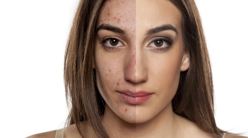 Soğuk bir duşun cilde olan 4 harika faydası