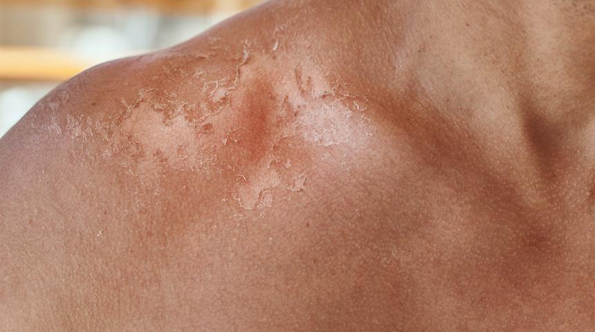 Uzmanlardan ölü deri uyarısı: Lekelenmemek için...