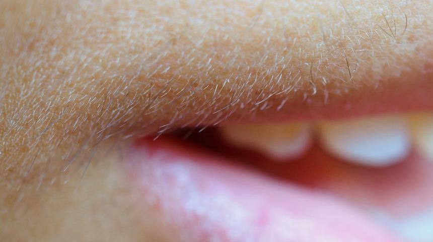 Bu hastalığın habercisi! Tüylenme yaşıyor sivilceleriniz varsa...