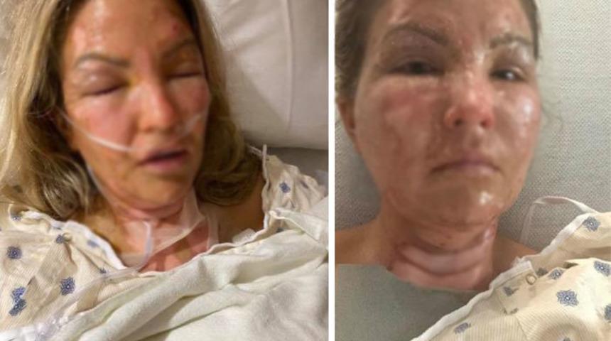 Dezenfektan kullandıktan sonra mum yakan kadının vücudu alev aldı