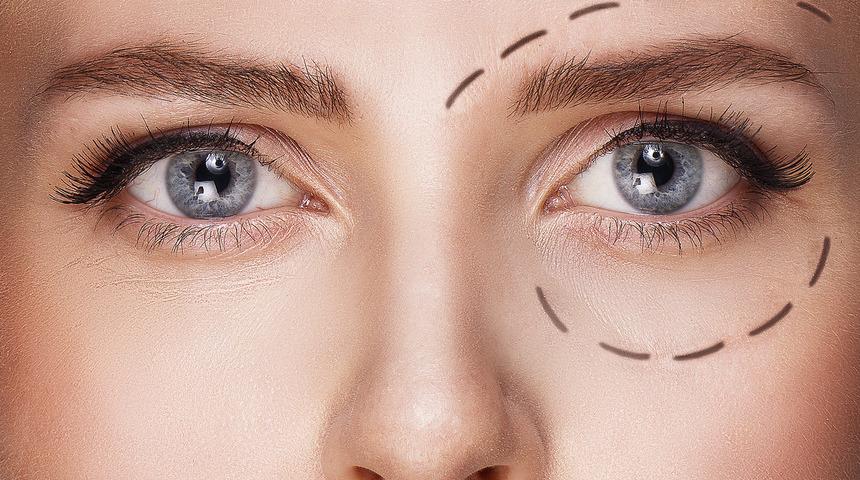 Ameliyatsız g&ouml;z kapağı estetiği m&uuml;mk&uuml;n m&uuml;?